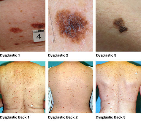 Is there a need to remove an atypical mole?